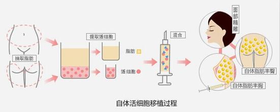 微整形培训之自体脂肪填充技术