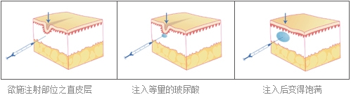 微整形培训之玻尿酸注射技术